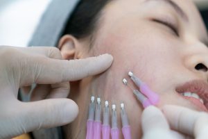 Descubra os segredos dos Fios de PDO para o rejuvenescimento facial e corporal!